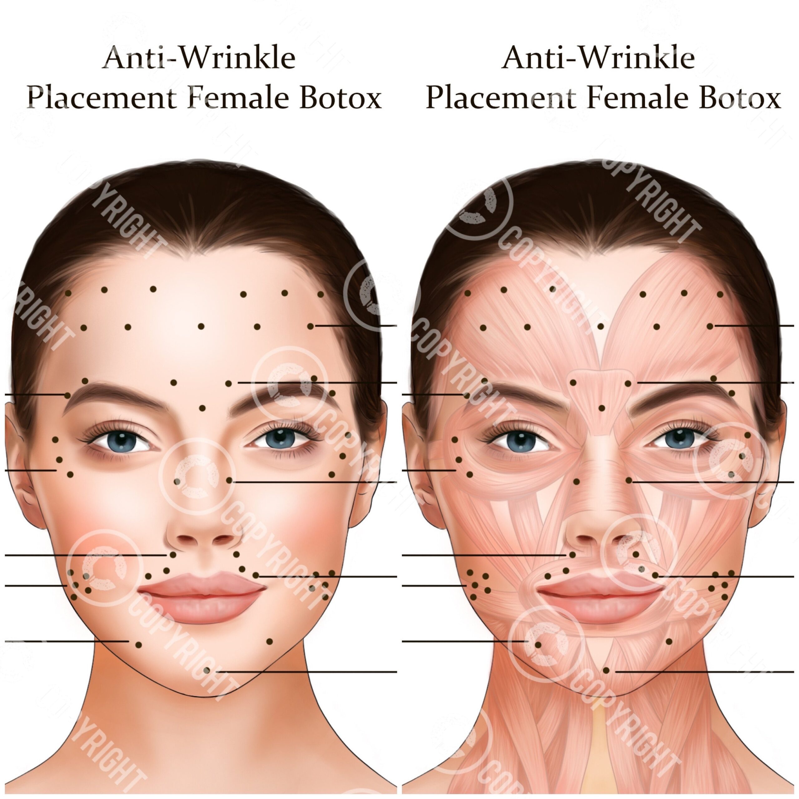 Botox Injection Points Bundle Botox U0026 Filler Injector Anatomy Art Esthetician Aesthetics Dermatology Medspa Digital Download Etsy