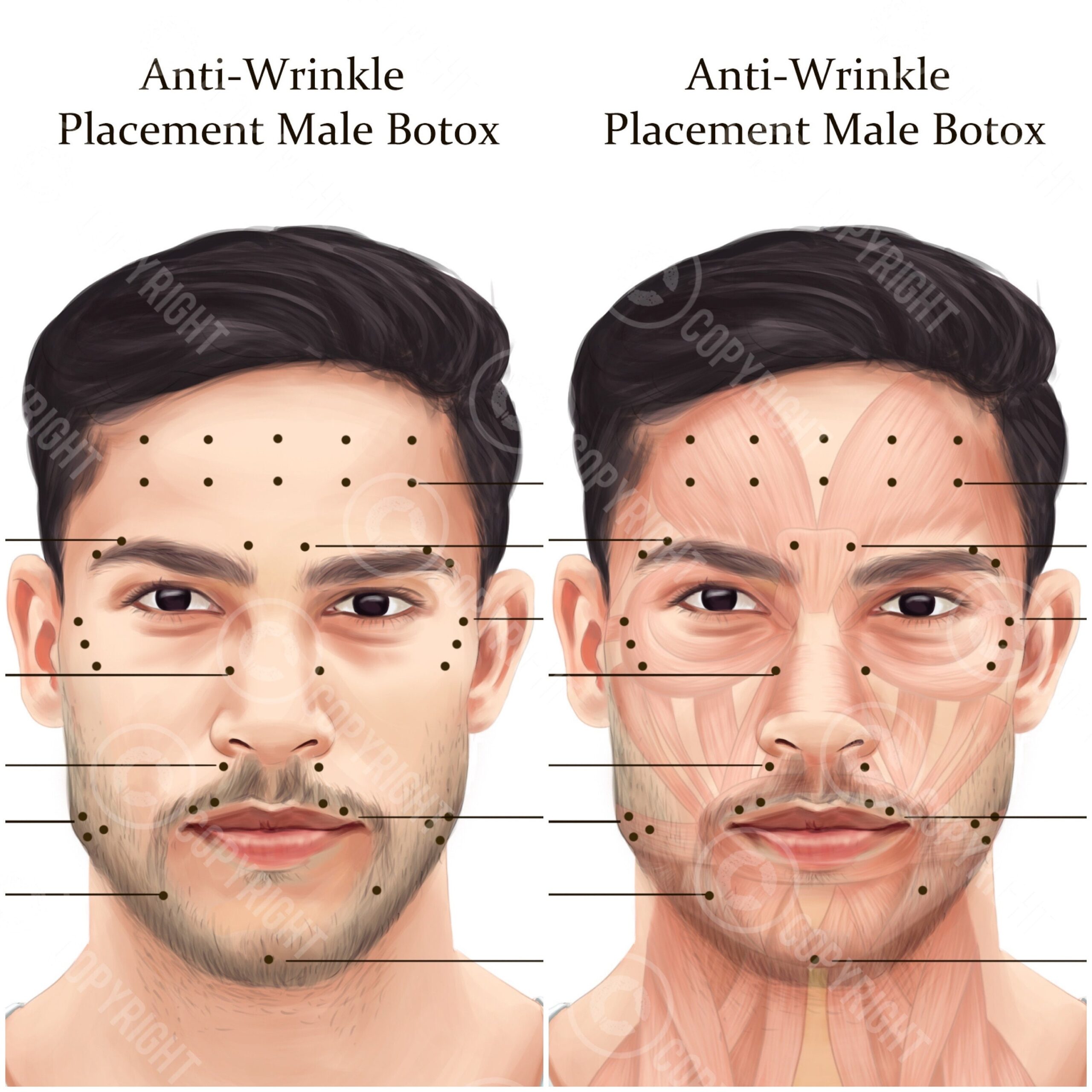 Printable Botox Injection Face Map Etsy